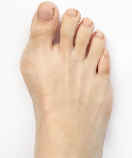 Hallux valgus πριν χρησιμοποιήσετε το σπρέι Hondro Sol Valgus