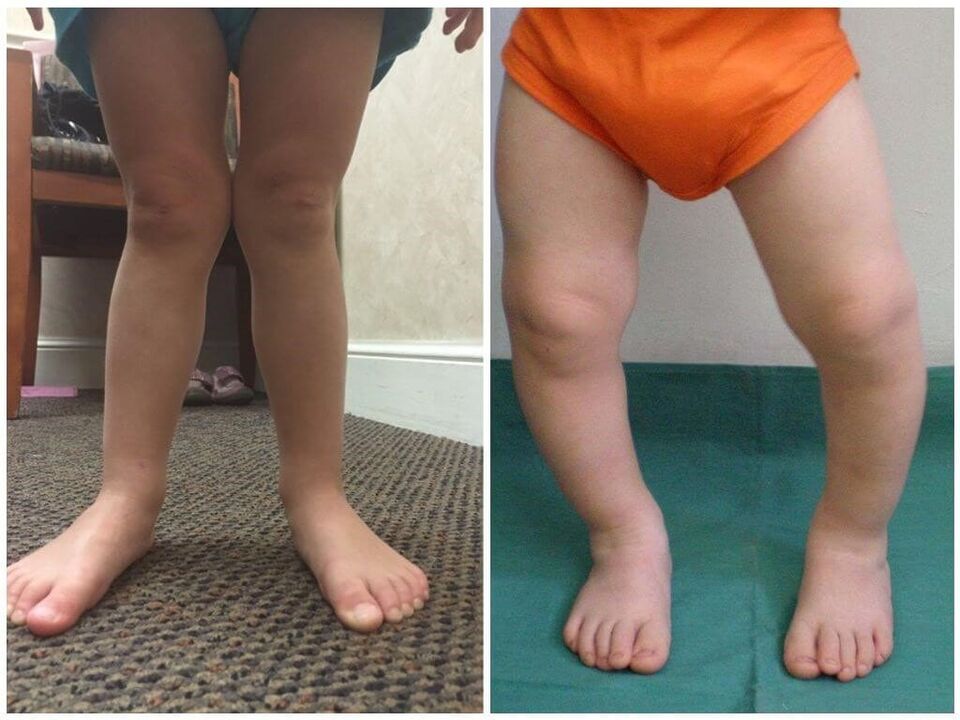 Η παραμόρφωση του Valgus προκλήθηκε στα παιδιά