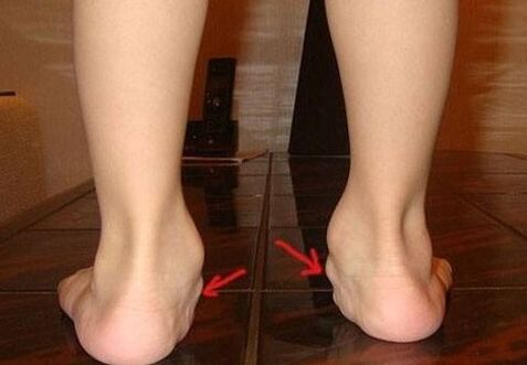 Valgus παραμόρφωση των ποδιών στα παιδιά