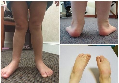 Παραμόρφωση Valgus σε παιδιά