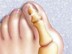 Παραμόρφωση Hallux Valgus